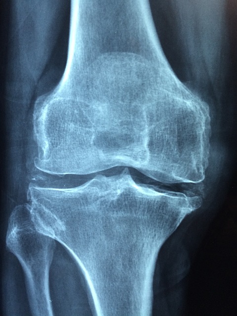 Parkinson's Pain -phot of a knee x-ray to show joint pain